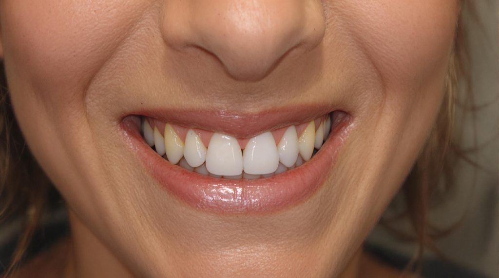 Témoignage de greffe osseuse dentaire réussie