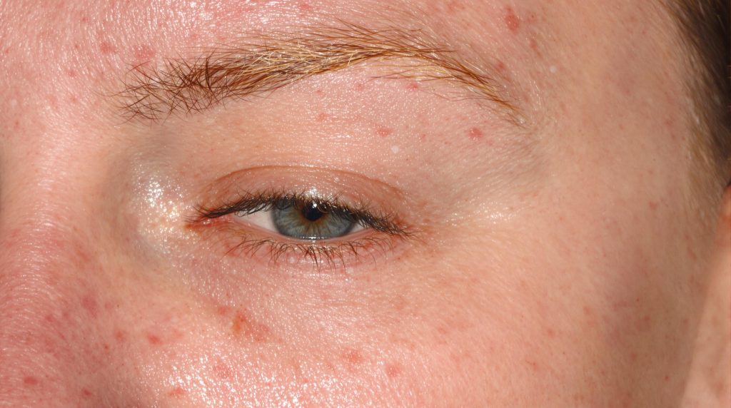 Traitement des microkystes sur le visage