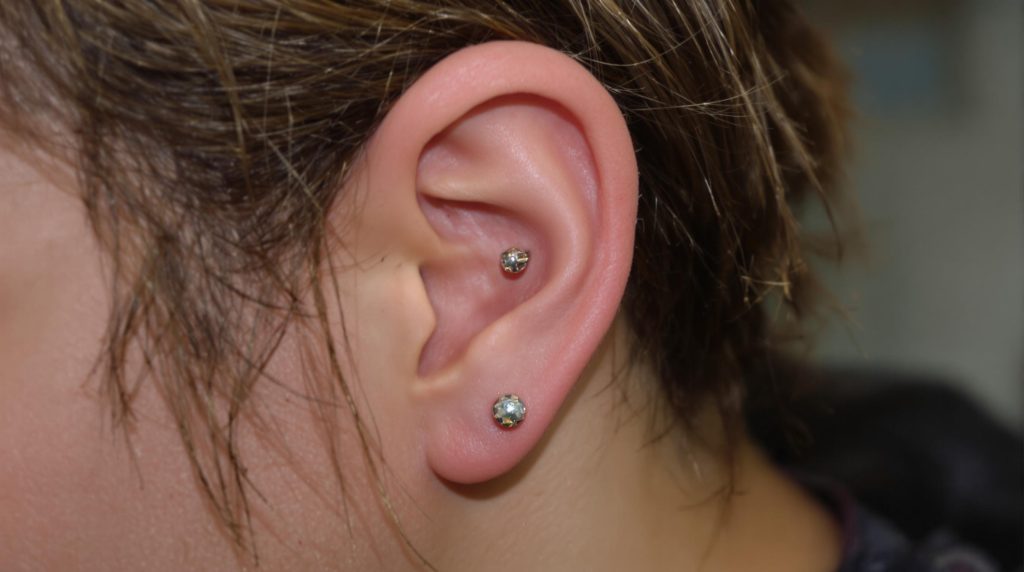 Image d'un cheloide sur un piercing