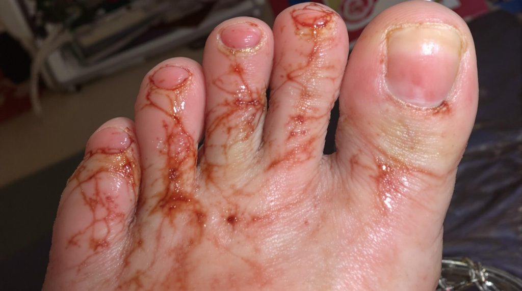 Image illustrant lalgodystrophie au pied